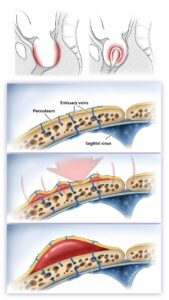 What is a cephalohematoma? 7 300435023 5554921581213224 1714360764347794998 n | New Jersey Pediatric Neuroscience Institute