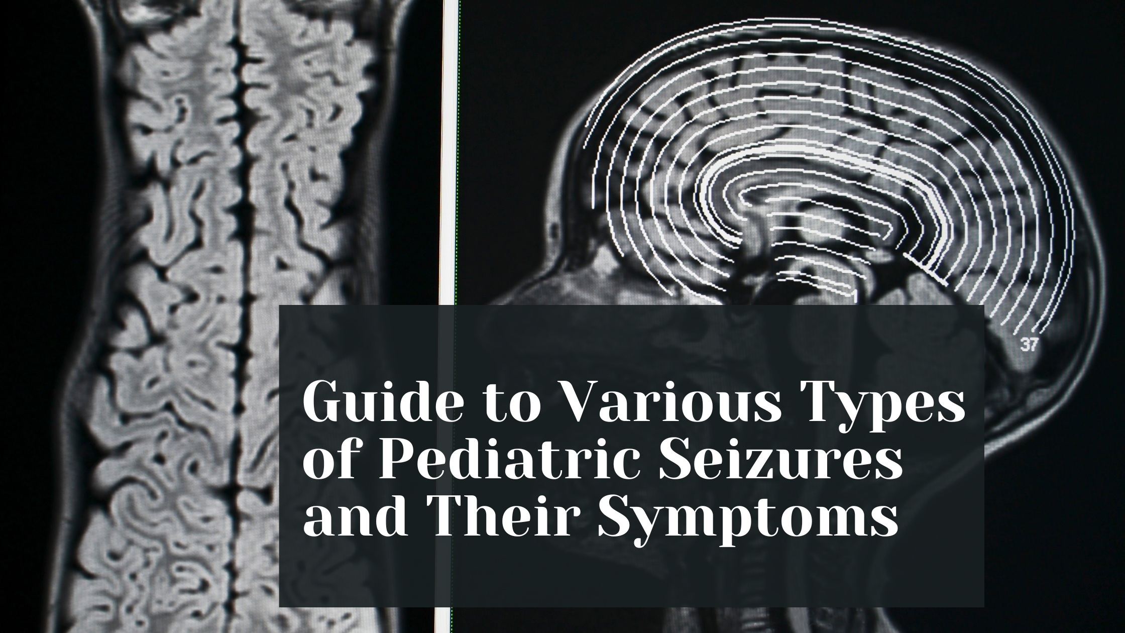 Guide to Various Types of Pediatric Seizures and Their Symptoms