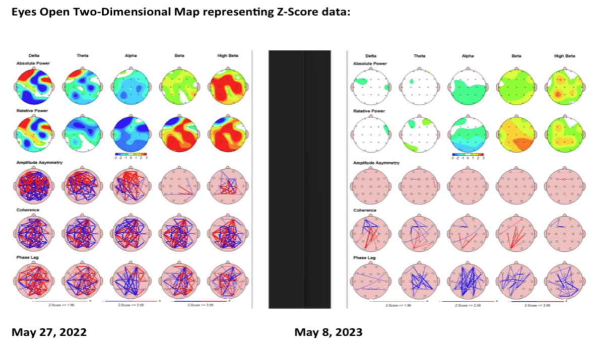 Example qEEG brain map showing brain activity patterns before and after treatment