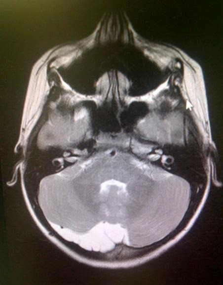 MRI example of an arachnoid cyst in the brain