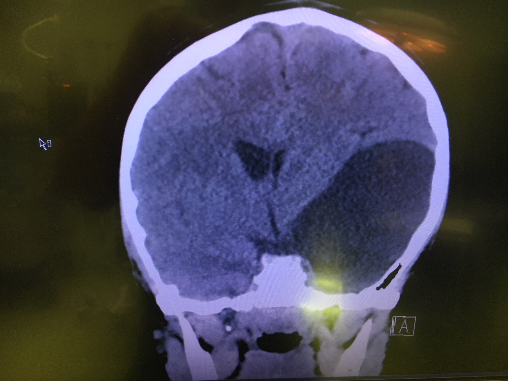 CT scan showing a large arachnoid cyst in the brain