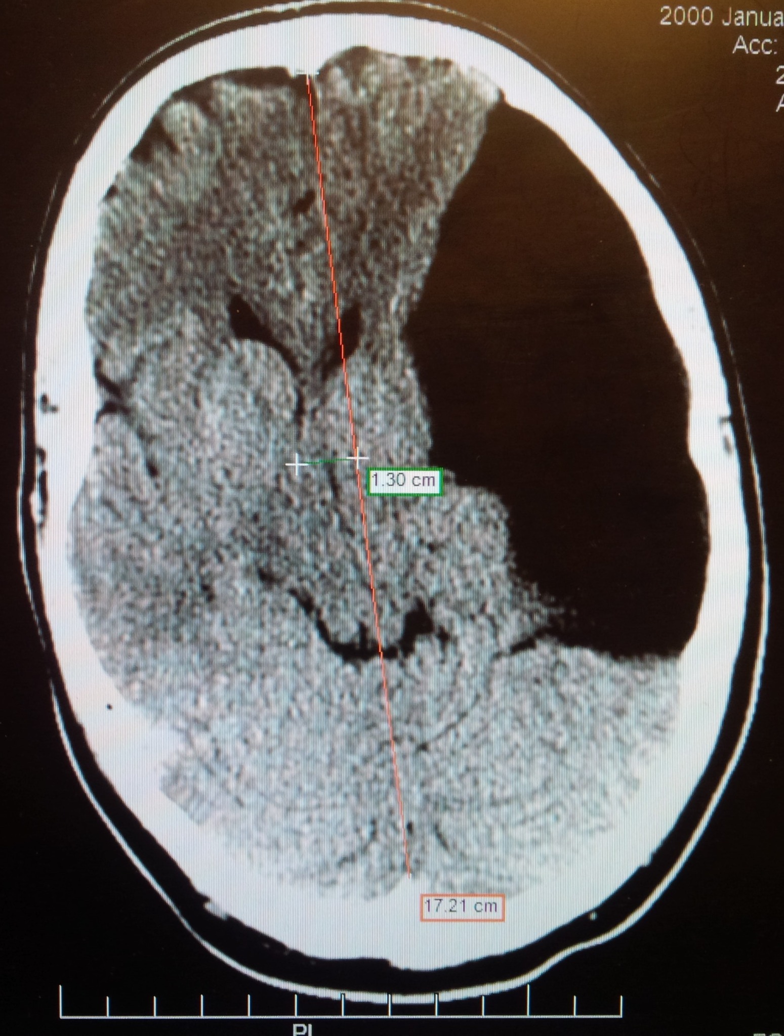 CT scan showing a large arachnoid cyst with pressure effect
