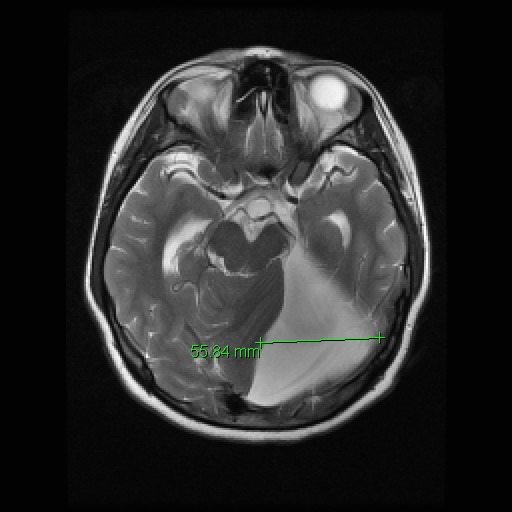 MRI example of a posterior fossa arachnoid cyst near the back of the brain