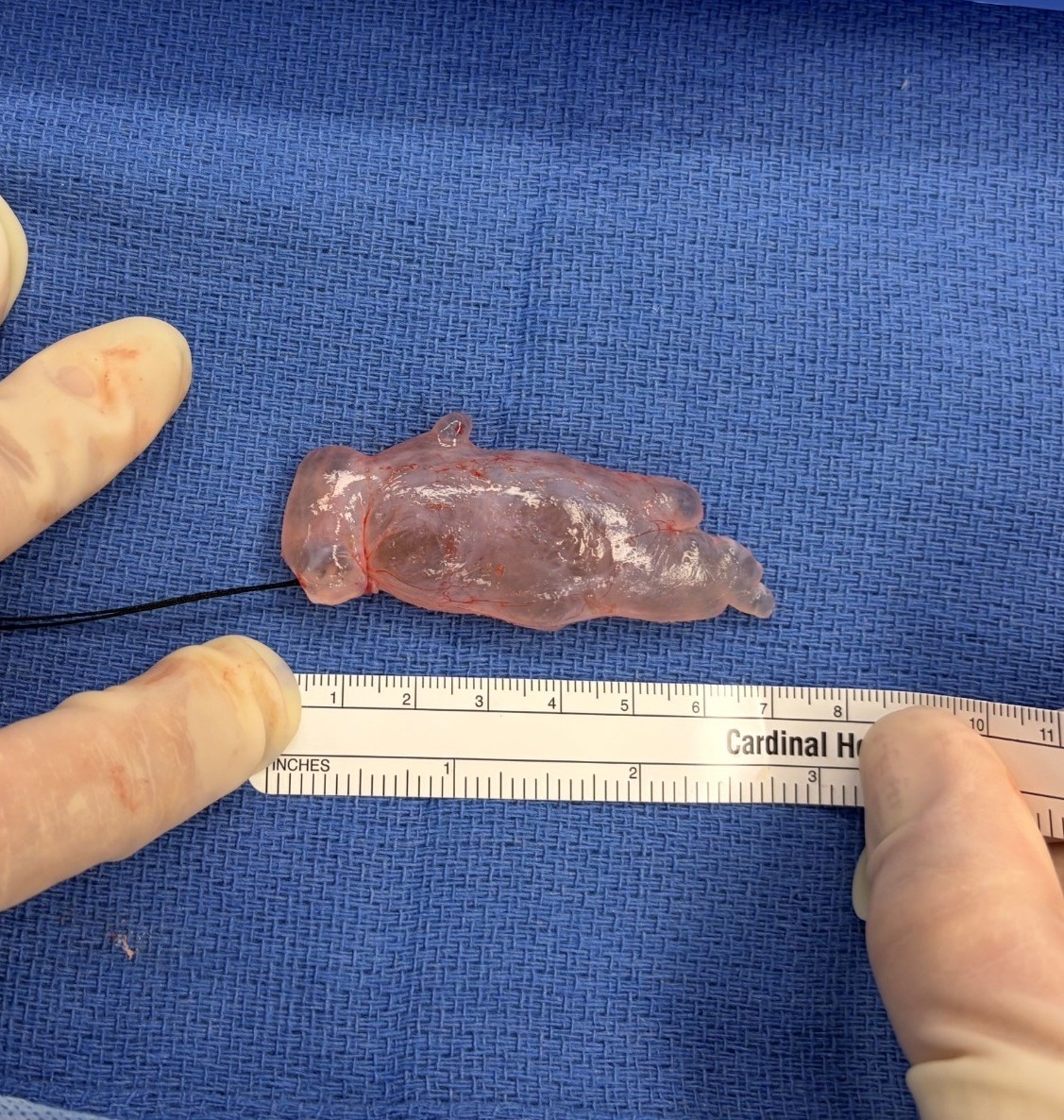 Surgical example of a resected spinal arachnoid cyst