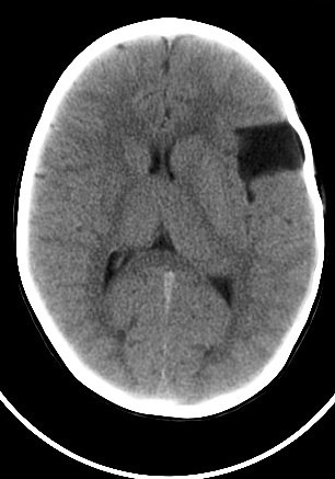 CT scan example of a temporal arachnoid cyst near the side of the brain